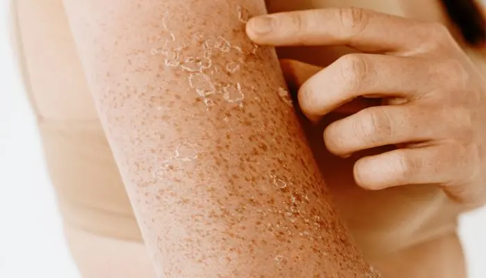 Manchas Marrones en la Piel: Causas, Tratamientos y Cómo Afectan Tu Salud - Cómo se llama la enfermedad de manchas en la piel manchas en la piel marrones - Cómo se llama la enfermedad de manchas en la piel