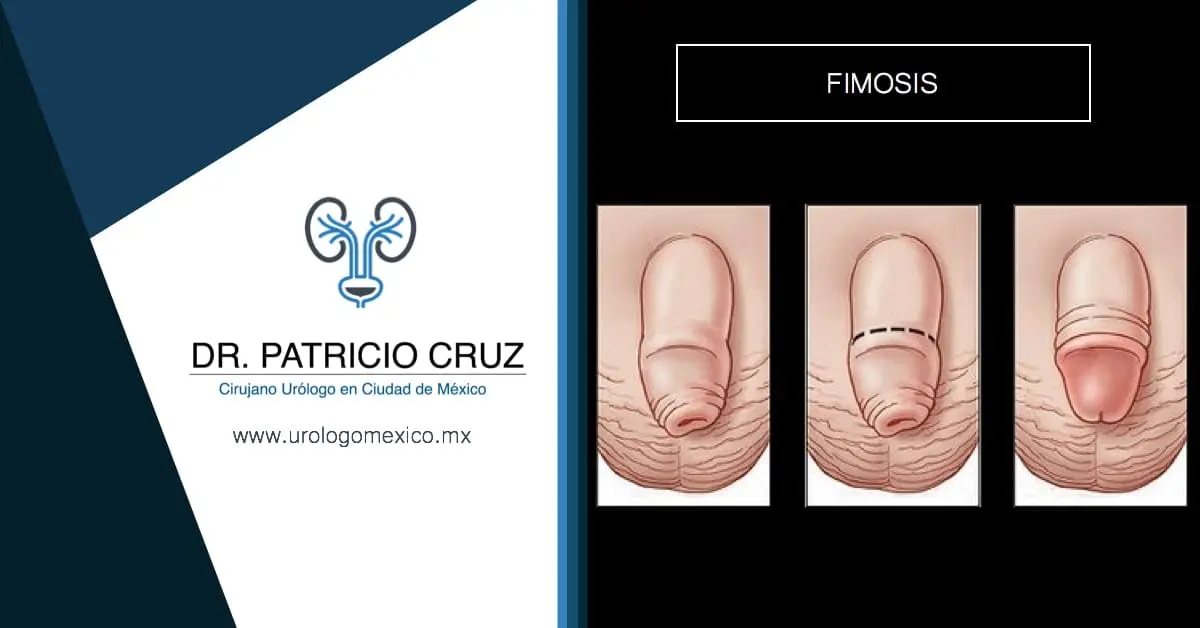 Fimosis: Causas, Síntomas y Tratamientos del Prepucio - Cómo se llama la enfermedad del prepucio enfermedades del prepucio - Cómo se llama la enfermedad del prepucio