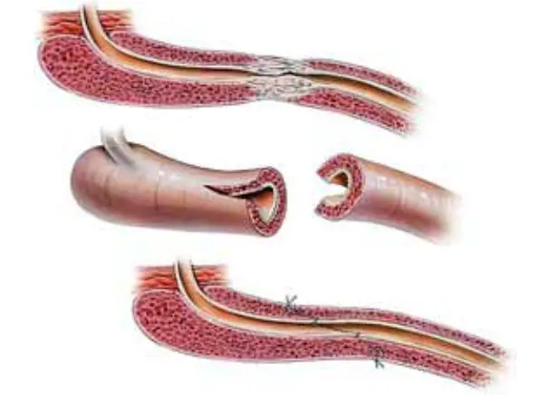 Estenosis de uretra: causas, síntomas, tratamiento y recuperación - Cómo se llama la pastilla para dilatar la uretra estenosis de uretra - Cómo se llama la pastilla para dilatar la uretra