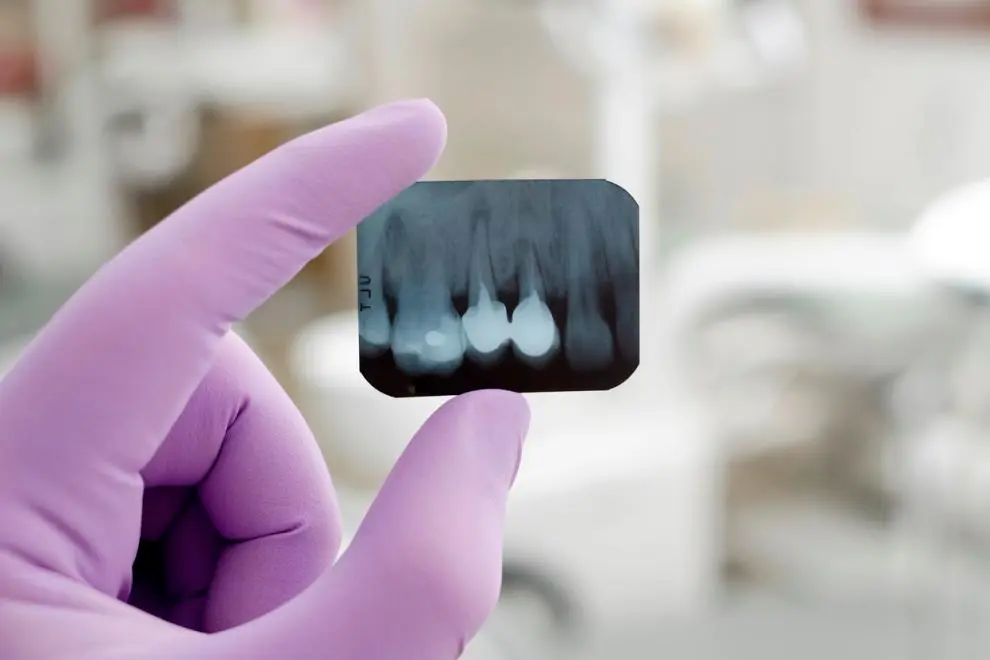 Radiografías Dentales: Tipos, Importancia y Evolución - Cómo se llama la radiografía de toda la boca radiologia dental - Cómo se llama la radiografía de toda la boca
