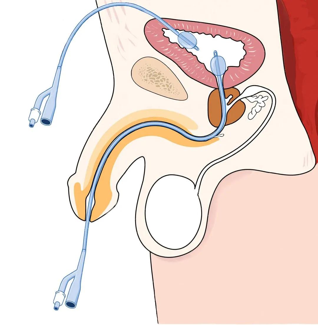 sonda vesical en hombres - Cómo se llama la sonda que le ponen a los hombres