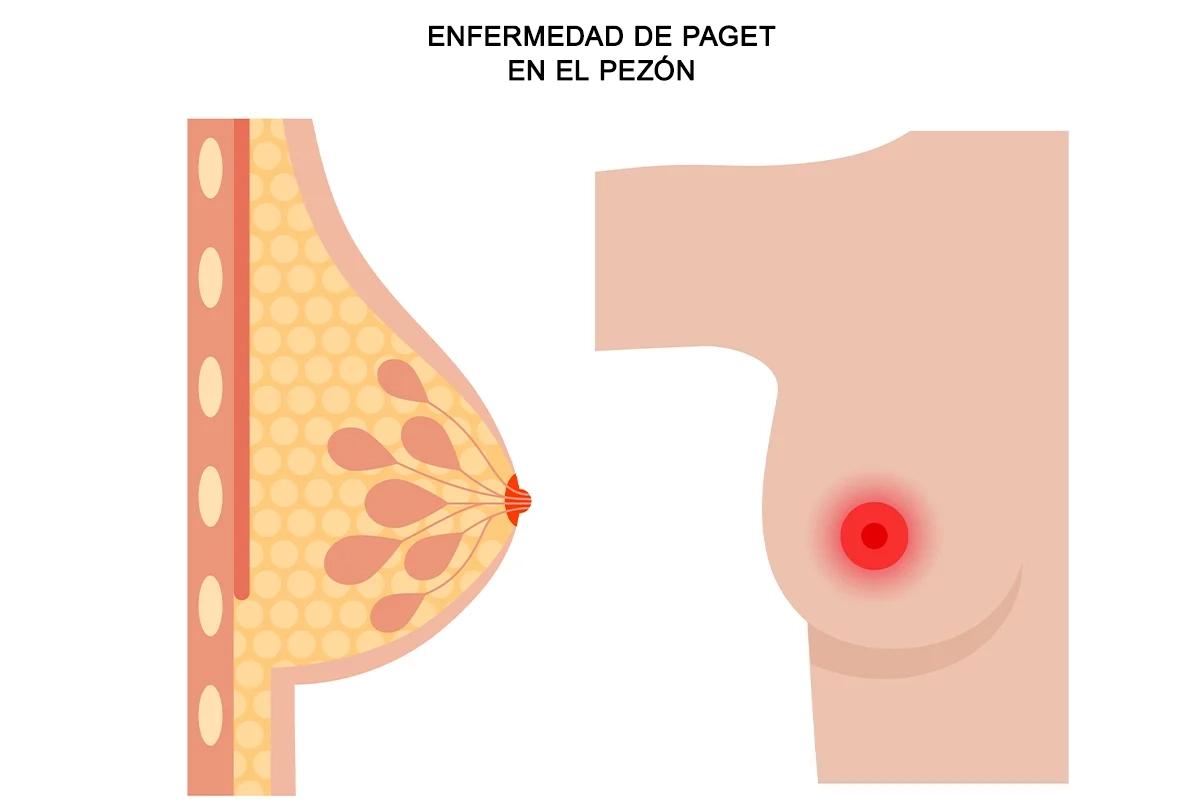Enfermedad de Paget: Causas, Síntomas y Tratamiento - Cómo se manifiesta la enfermedad de Paget paget mama - Cómo se manifiesta la enfermedad de Paget