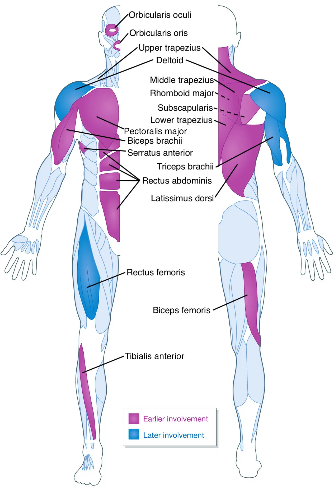 Distrofia Facioescapulohumeral (FSHD): Una mirada a la debilidad muscular progresiva - Cómo se manifiesta la FSHD distrofia facio escapulo humeral - Cómo se manifiesta la FSHD