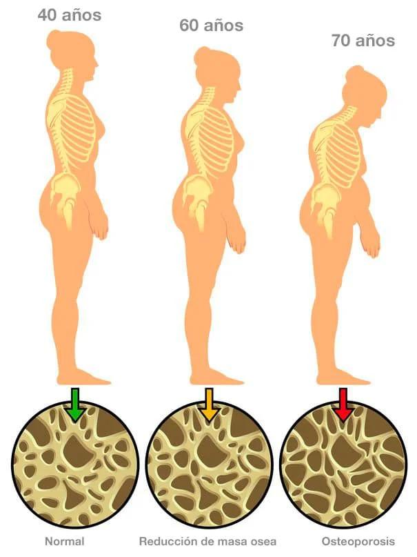 la osteoporosis tiene cura - Cómo se puede frenar la osteoporosis