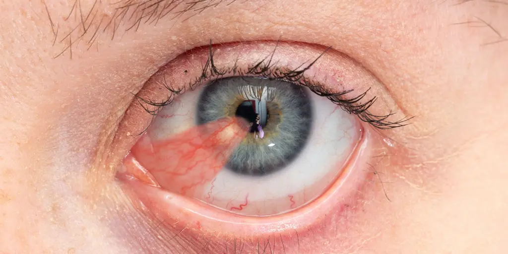 Pterigion: Causas, Síntomas y Tratamiento - Cómo se quita el pterigion en el ojo pterígio - Cómo se quita el pterigion en el ojo