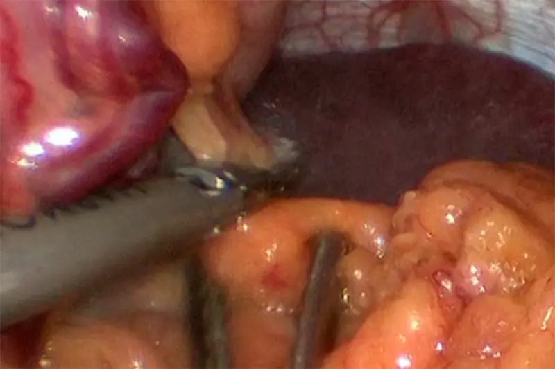 Esplenectomía: Qué es, por qué se realiza y qué esperar - Cómo se quita la esplenomegalia esplenectomia - Cómo se quita la esplenomegalia