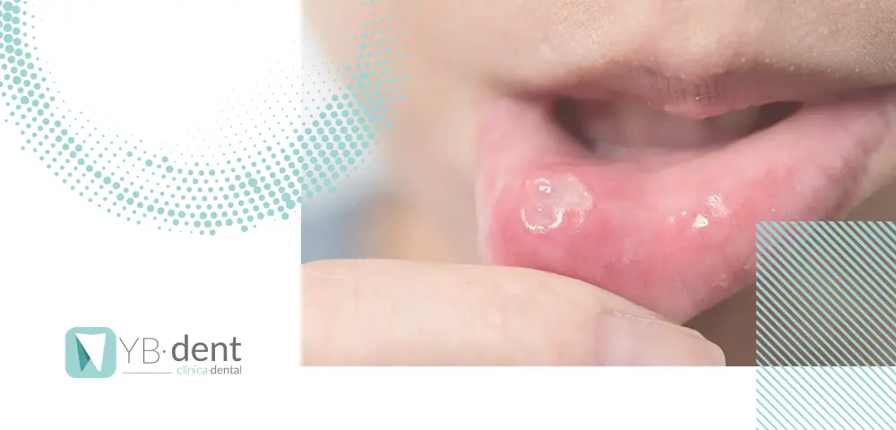 Gingivoestomatitis: Causas, Síntomas, Diagnóstico y Tratamiento - Cómo se quita la estomatitis gingivoestomatitis - Cómo se quita la estomatitis