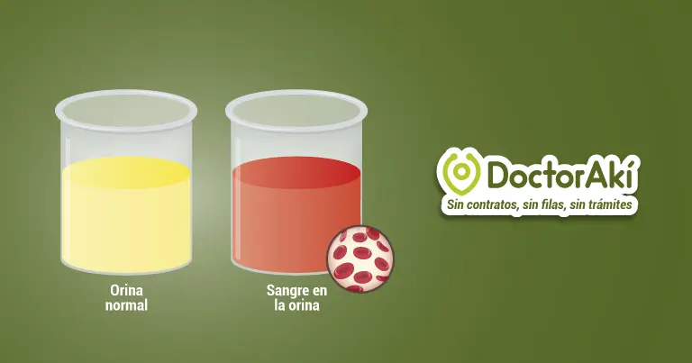 hematuria en orina - Cómo se quita una hematuria