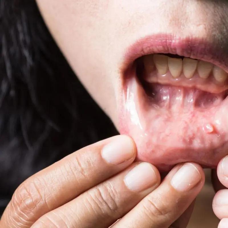 Verrugas en las Encías: Causas, Tratamiento y Cómo Eliminarlas - Cómo se quitan las verrugas bucales verrugas en las encias - Cómo se quitan las verrugas bucales