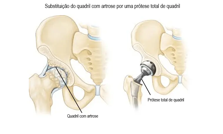 Artroplastia: Reemplazo Articular para una Vida Activa - Cómo se realiza la artroplastia de rodilla artroplastia - Cómo se realiza la artroplastia de rodilla