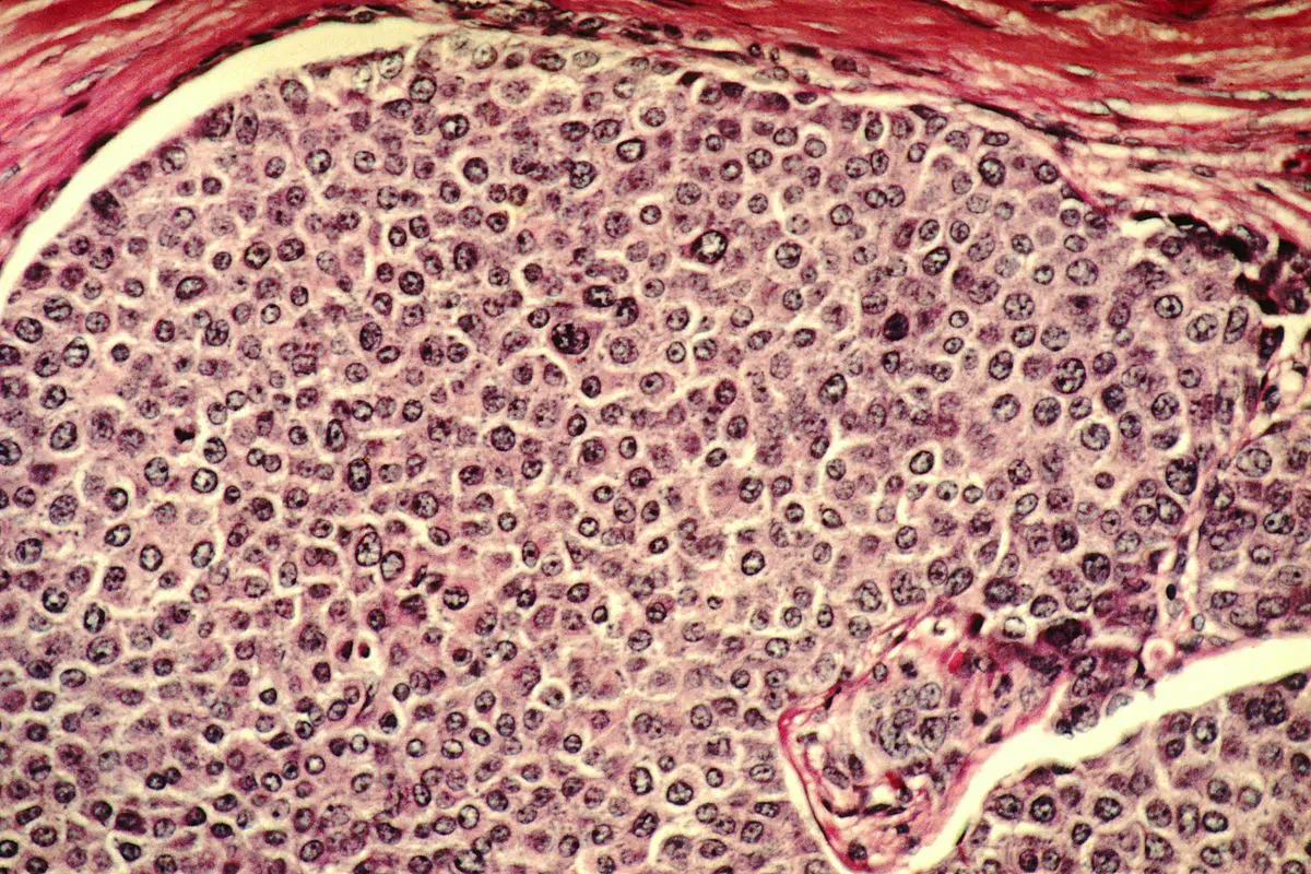 Células Cancerígenas: Un Viaje al Interior del Crecimiento Descontrolado - Cómo se reconoce una célula cancerosa celula cancerigena - Cómo se reconoce una célula cancerosa
