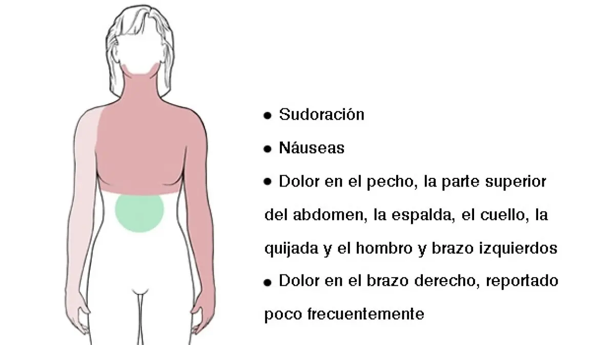 Ataque Cardíaco en Mujeres: Síntomas, Factores de Riesgo y Prevención - Cómo se refleja un infarto en mujeres ataque cardiaco en mujeres - Cómo se refleja un infarto en mujeres