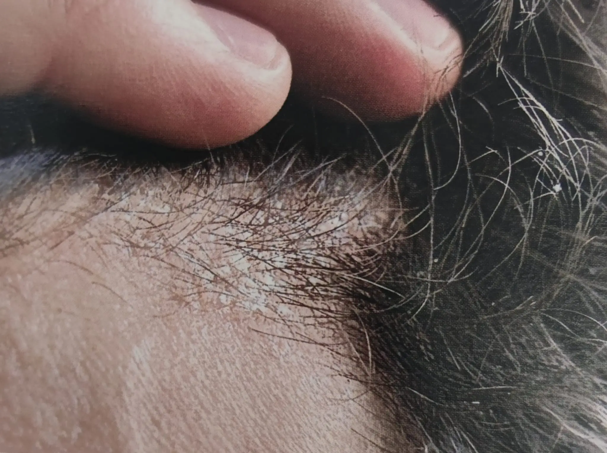 La Caspa: ¿Es Contagiosa o un Mito? - Cómo se te pega la caspa la caspa es contagiosa - Cómo se te pega la caspa