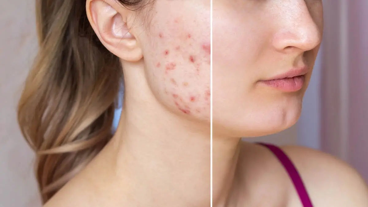 Amoxicilina para el Acné: Usos, Efectos Secundarios y Alternativas - Cómo se toma la amoxicilina para el acné amoxicilina para el acne - Cómo se toma la amoxicilina para el acné