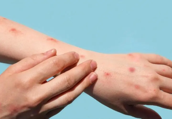 monkeypox - Cómo se transmite el monkey pox