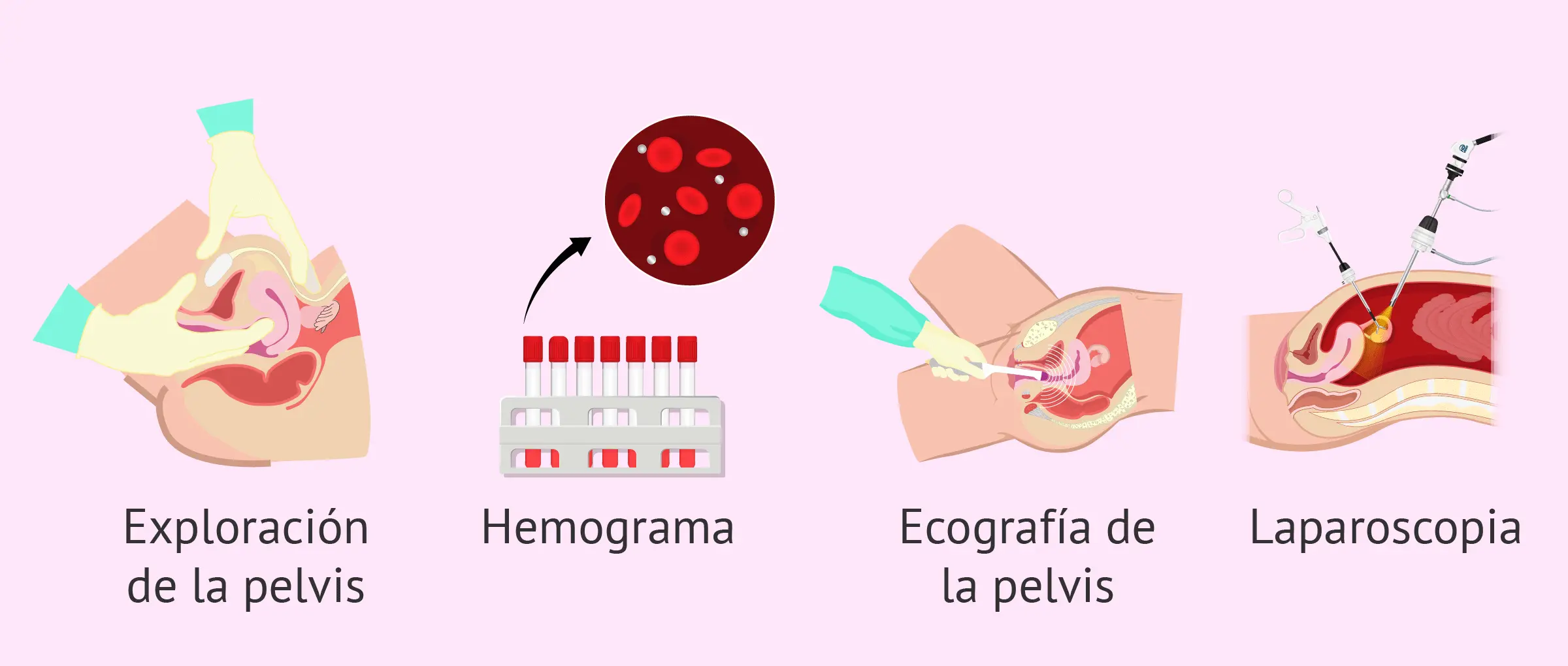 Tratamiento para la Enfermedad Pélvica Inflamatoria: Guía Completa - Cómo se trata la enfermedad pélvica inflamatoria tratamiento para enfermedad pelvica inflamatoria - Cómo se trata la enfermedad pélvica inflamatoria