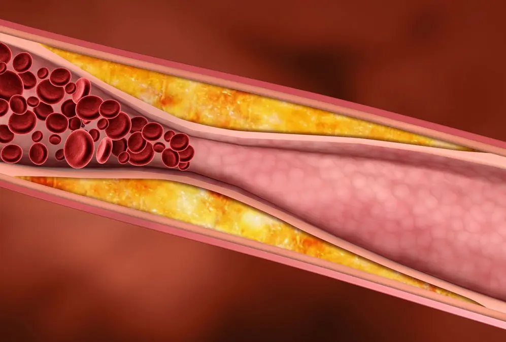 Cómo eliminar placas de ateroma: Guía completa para mejorar tu salud cardiovascular - Cómo se trata un ateroma como eliminar placas de ateroma - Cómo se trata un ateroma