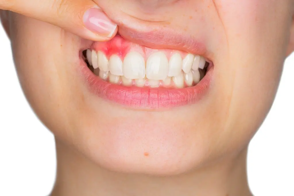 Gingivitis Bucal: Causas, Síntomas, Tratamiento y Prevención - Cómo se trata una gingivitis gingivitis bucal - Cómo se trata una gingivitis