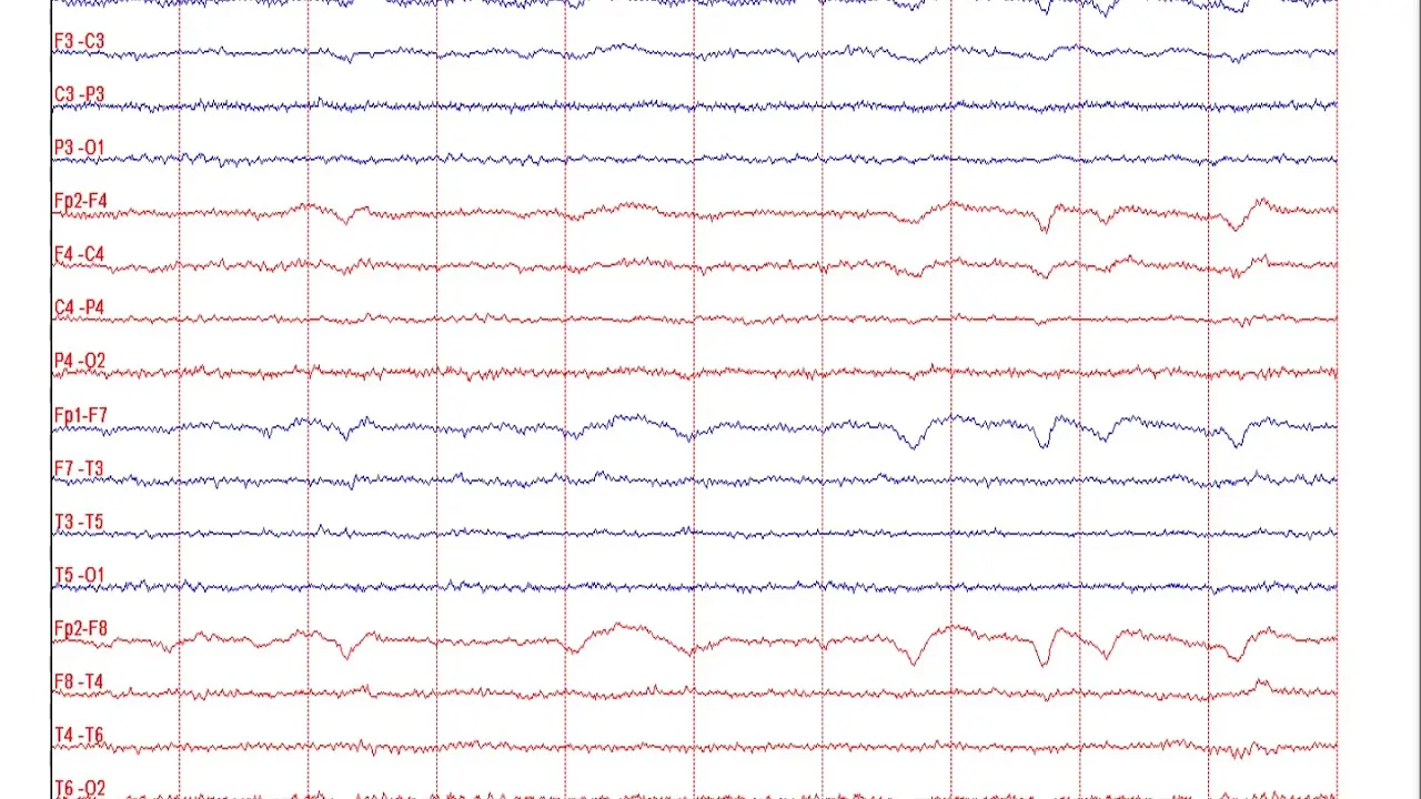 electroencefalograma normal - Cómo se ve la epilepsia en un electroencefalograma