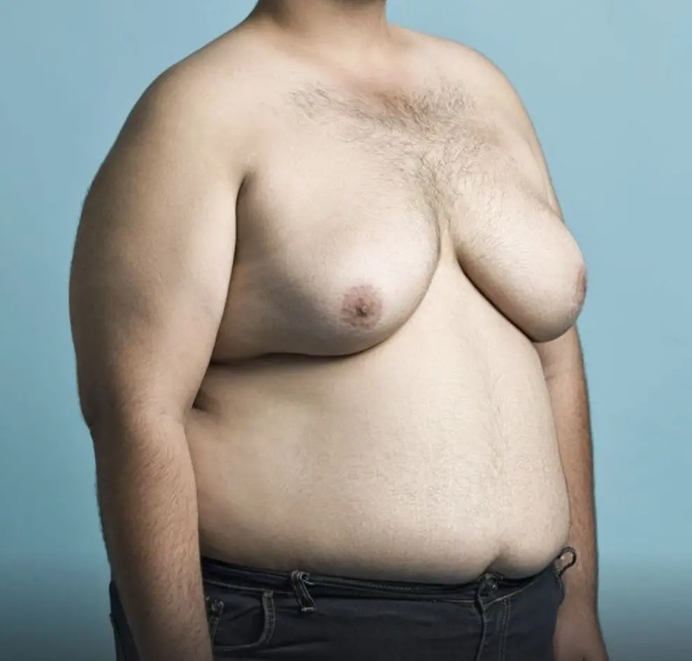 Ginecomastia en Hombres: ¿Cómo Diferenciarla de la Grasa del Pecho? - Cómo se ve la ginecomastia en hombres hombres con senos - Cómo se ve la ginecomastia en hombres
