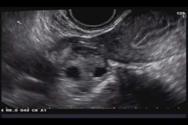 <b>Mioma Uterino</b>: Diagnóstico mediante Ecografía - Cómo se ve un mioma en una ecografía mioma uterino ecografia - Cómo se ve un mioma en una ecografía