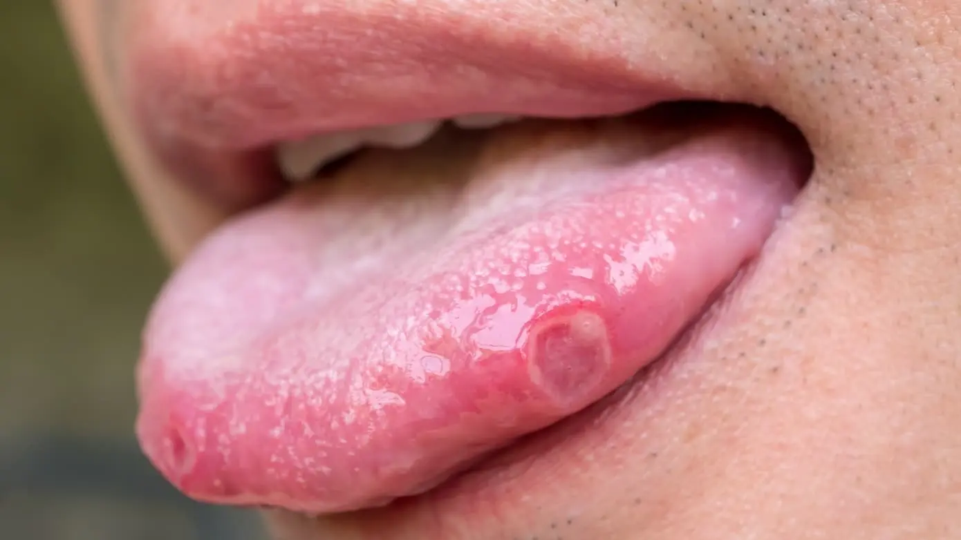 Llagas en la Lengua: ¿Covid o Lengua Geográfica? - Cómo se ve una lengua con virus llagas en la lengua covid - Cómo se ve una lengua con virus