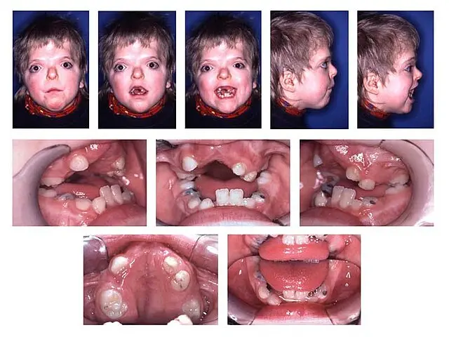 sindrome de apert - Cómo síndrome de Apert o de Russell Silver