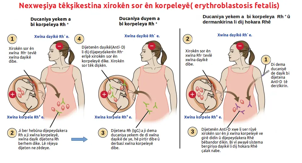 Eritroblastosis Fetal: Causas, Diagnóstico y Tratamiento - Cómo solucionar la eritroblastosis fetal eritroblastosis fetal - Cómo solucionar la eritroblastosis fetal