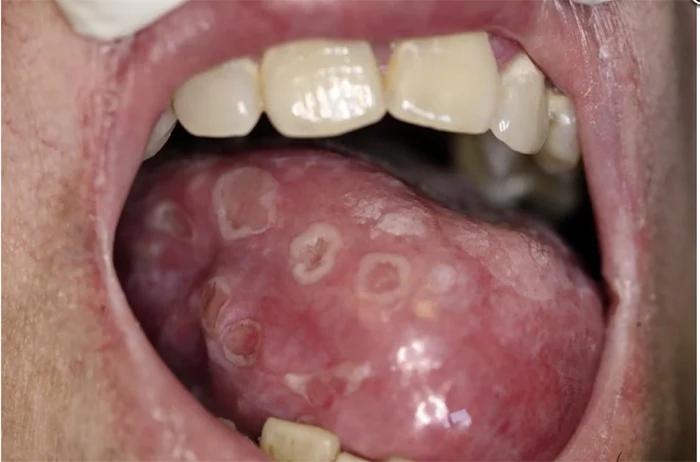 Chancro Sifilis Bucal: Síntomas, Diagnóstico y Tratamiento - Cómo son las llagas de sífilis en la boca chancro sifilis bucal - Cómo son las llagas de sífilis en la boca