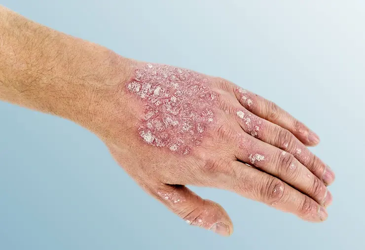 Psoriasis: Todo sobre las manchas y sus tipos - Cómo son las manchas de psoriasis imagenes de psoriasis - Cómo son las manchas de psoriasis
