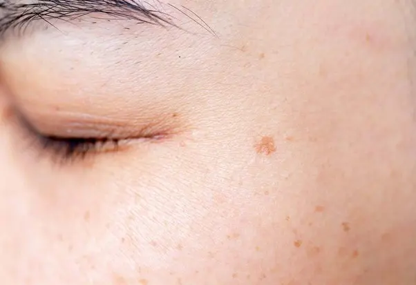 Manchas Marrones en la Piel: Causas, Tratamientos y Cómo Afectan Tu Salud - Cómo son las manchas en la piel por estrés manchas en la piel marrones - Cómo son las manchas en la piel por estrés