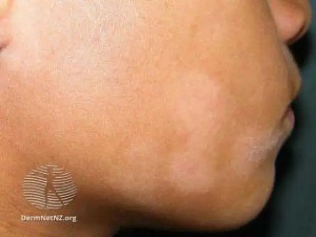 Manchas en la Piel de los Niños: Causas, Síntomas y Diagnóstico - Cómo son las manchas en la piel por leucemia en niños manchas en la piel niños - Cómo son las manchas en la piel por leucemia en niños