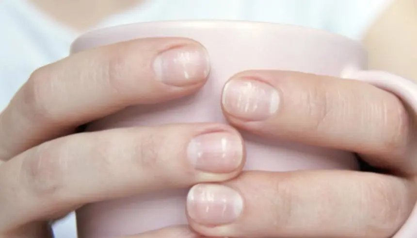 Uñas y Diabetes: Una Relación Importante - Cómo son las uñas de uña persona con diabetes uñas diabetes - Cómo son las uñas de uña persona con diabetes