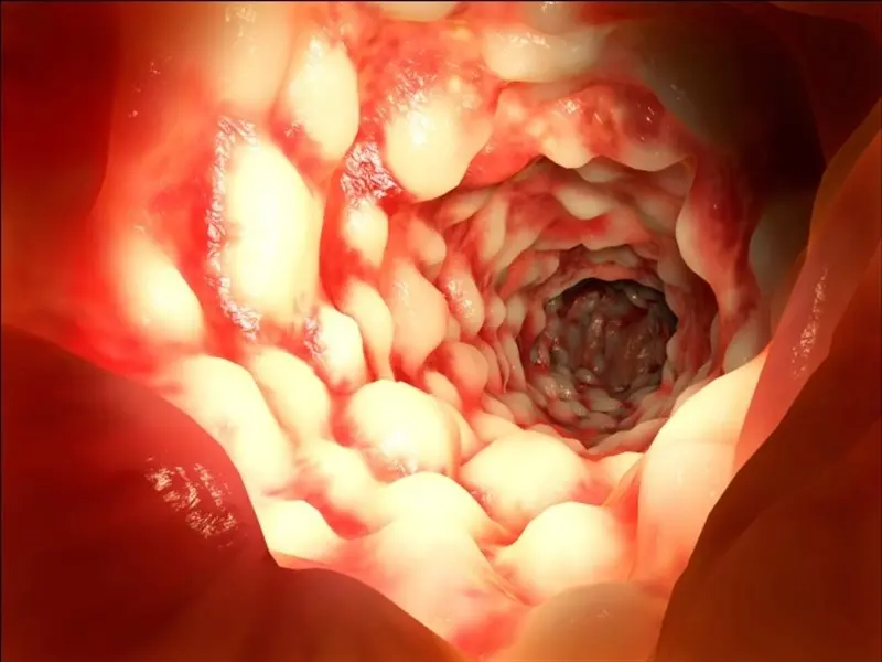Gadolax para colonoscopia: Guía completa para su uso - Cómo tomar gadolax antes de una colonoscopia gadolax para colonoscopia - Cómo tomar gadolax antes de una colonoscopia