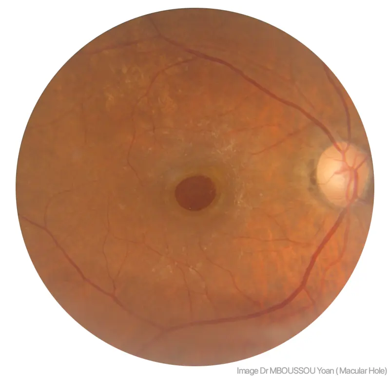 Agujero Macular: Causas, Síntomas y Tratamientos - Cómo tratar el agujero macular foramen macular - Cómo tratar el agujero macular