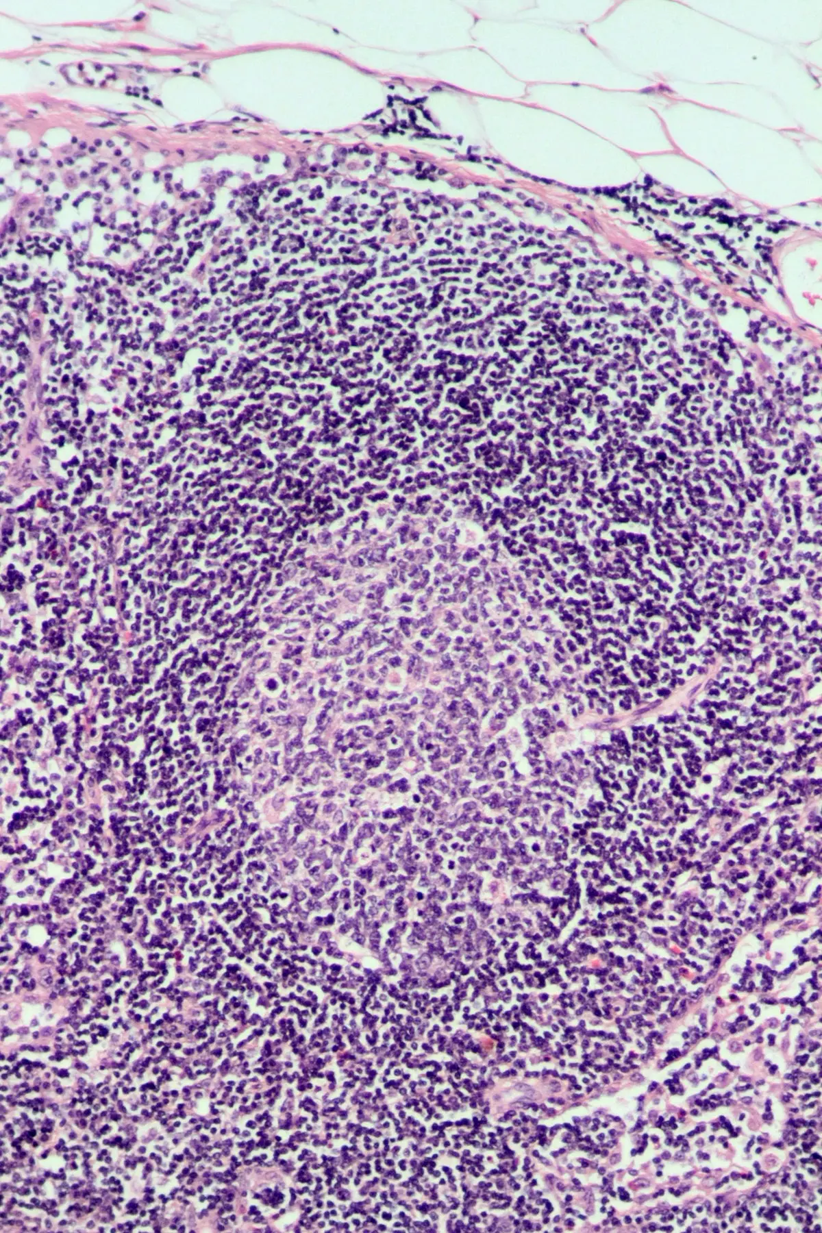 hiperplasia folicular linfoide - Cómo tratar la hiperplasia linfoide folicular
