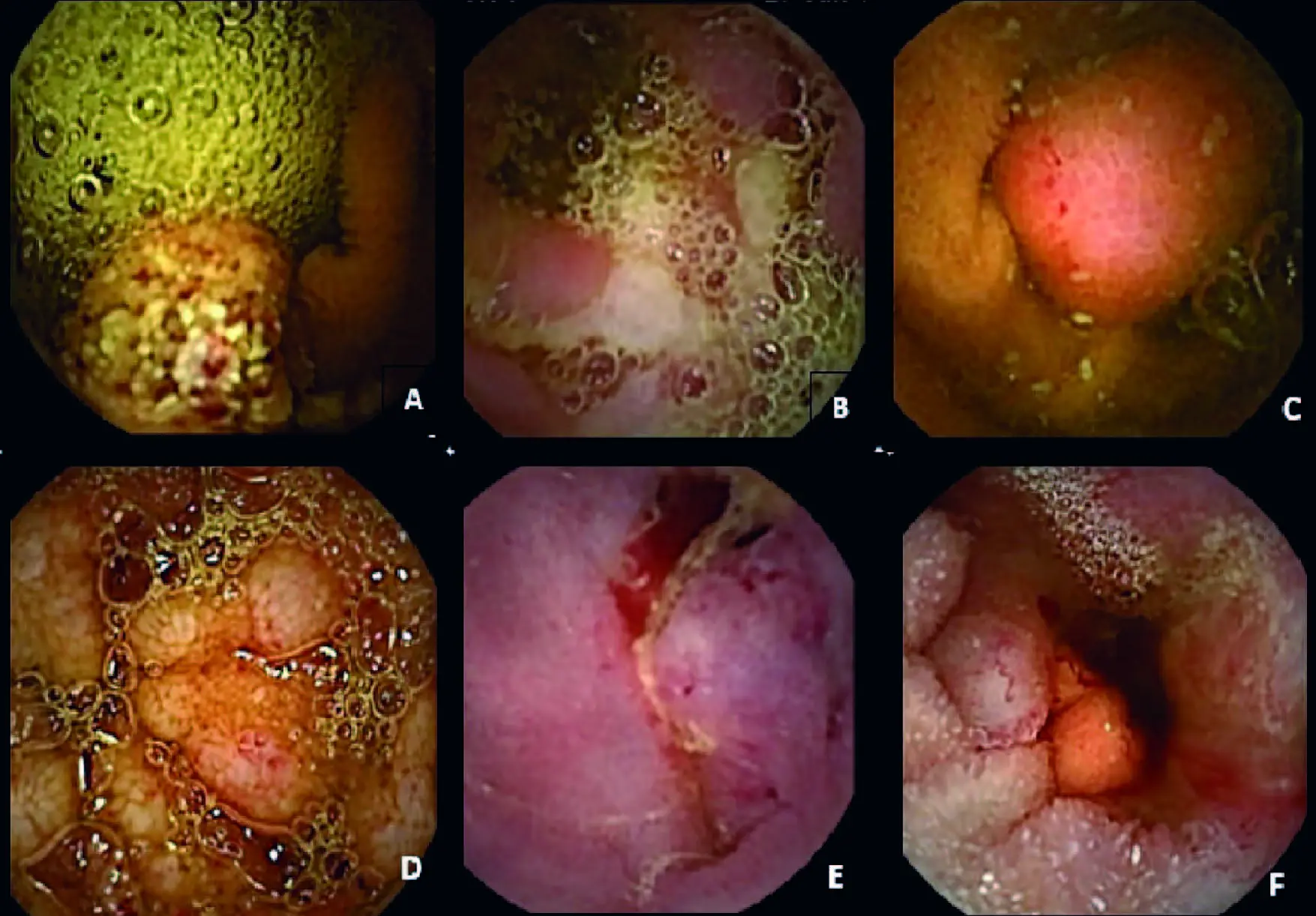 Tumor en el Intestino: Diagnóstico, Tratamiento y Todo lo que Necesitas Saber - Cómo tratar un tumor en el intestino tumor en el intestino - Cómo tratar un tumor en el intestino