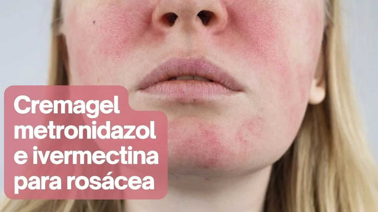 Metronidazol para la piel: ¿Cómo usarlo para la rosácea? - Cómo usar metronidazol en la cara metral crema rosacea - Cómo usar metronidazol en la cara