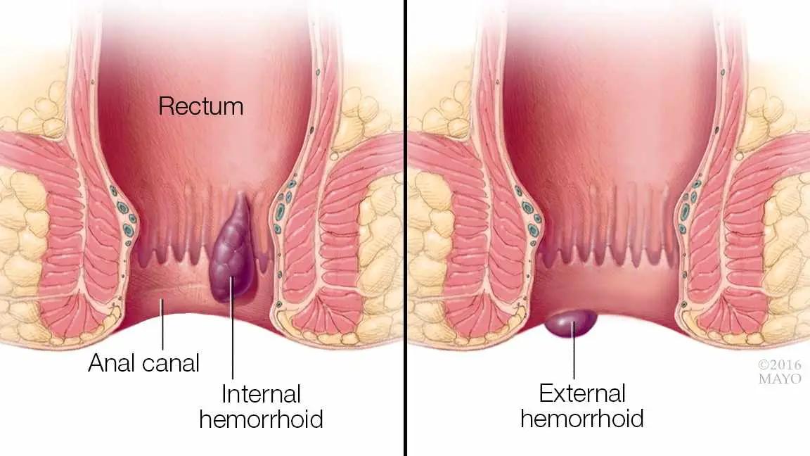 Cómo Curar las Hemorroides Externas: Guía Completa para Aliviar el Dolor y la Hinchazón - Cuál es el mejor medicamento para las hemorroides como curar las hemorroides externas - Cuál es el mejor medicamento para las hemorroides