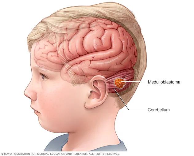 Tumores Cerebrales en Niños: Síntomas, Tipos y Diagnóstico - Cuál es el tipo de tumor cerebral más frecuente en los niños tumor cerebral en niños - Cuál es el tipo de tumor cerebral más frecuente en los niños