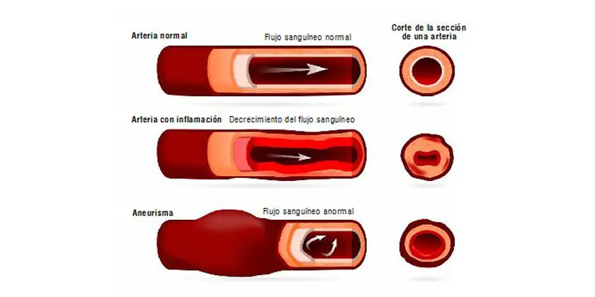 Aneurisma Disecante: Causas, Tratamiento y Complicaciones - Cuál es la causa principal de un aneurisma disecante aneurisma disecante - Cuál es la causa principal de un aneurisma disecante