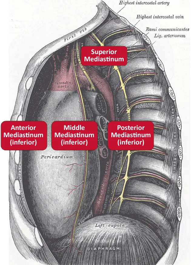 Cáncer de Mediastino Posterior: Síntomas, Tipos y Diagnóstico - Cuál es la neoplasia maligna más frecuente en el mediastino posterior cancer de mediastino sintomas - Cuál es la neoplasia maligna más frecuente en el mediastino posterior