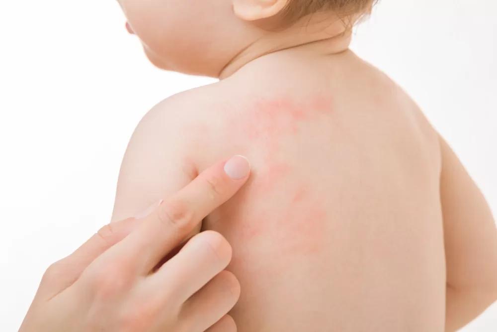 Alergias en la piel de los niños: Guía completa para padres - Cuáles son las alergias más comunes en los niños alergias en la piel en niños - Cuáles son las alergias más comunes en los niños