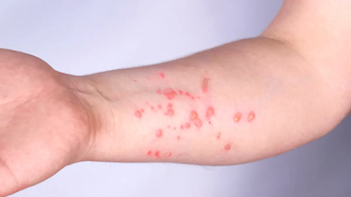 monkeypox - Cuáles son las consecuencias de la viruela del mono