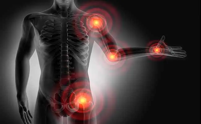 test para saber si tengo fibromialgia - Cuáles son los 18 puntos dolorosos de la fibromialgia