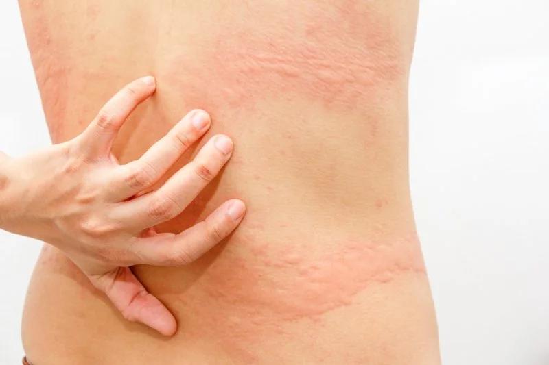 Tipos de alergia: Una guía completa para entender las reacciones alérgicas - Cuáles son los 4 tipos de alergia tipos de alergia - Cuáles son los 4 tipos de alergia