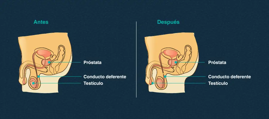 anticonceptivos quirurgicos - Cuáles son los anticonceptivos quirúrgicos voluntarios