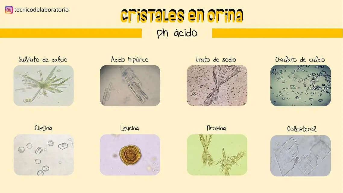 cristales en orina acida - Cuáles son los cristales ácidos en orina