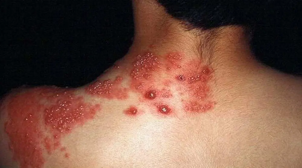 Efectos Secundarios de la Culebrilla: Dolor Crónico y Complicaciones - Cuáles son los efectos secundarios de la culebrilla efectos de la culebrilla - Cuáles son los efectos secundarios de la culebrilla