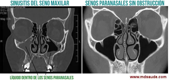 tomografia de senos paranasales con sinusitis - Cuáles son los hallazgos de la TC de la sinusitis
